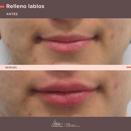 Aumento de labios