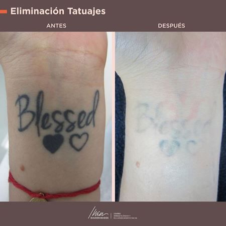Eliminación de tatuajes