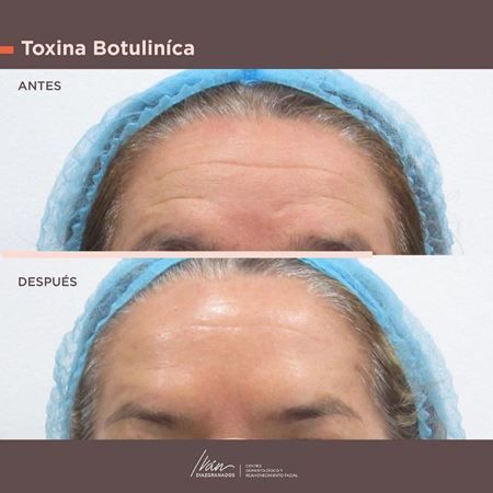 Toxina botulínica