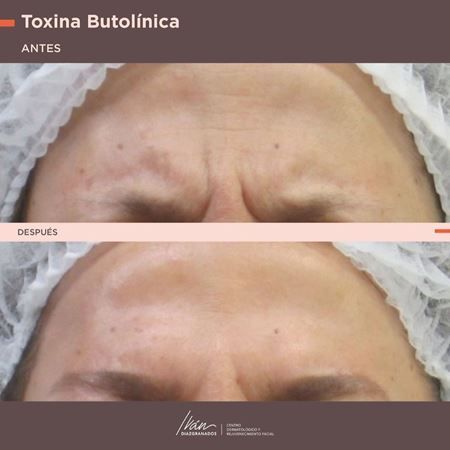 Toxina botulínica