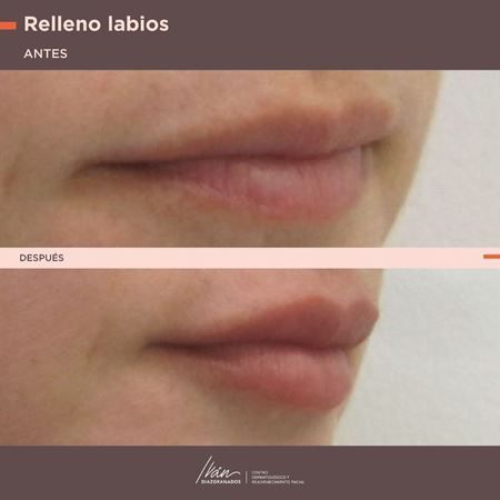 Aumento de labios