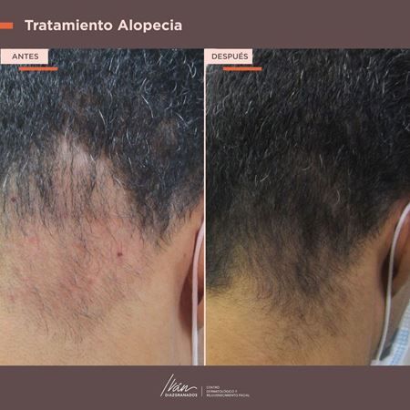 Alopecia