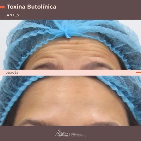 Toxina botulínica