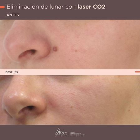 Cauterización de lesiones