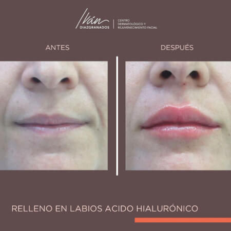 Aumento de labios