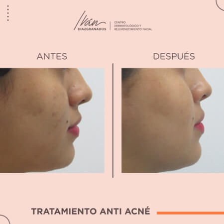 Acné