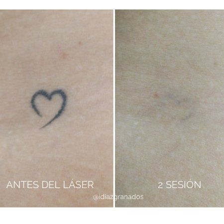 Eliminación de tatuajes