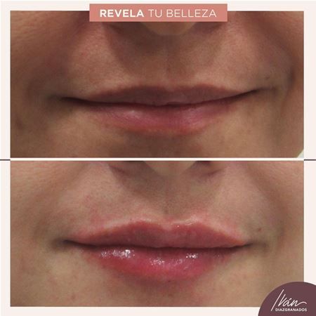 Aumento de labios