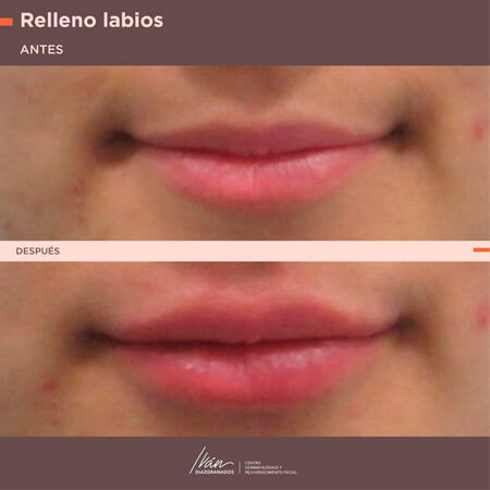 Aumento de labios