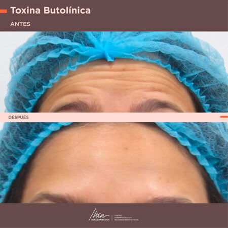 Toxina botulínica