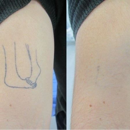 Eliminación de tatuajes
